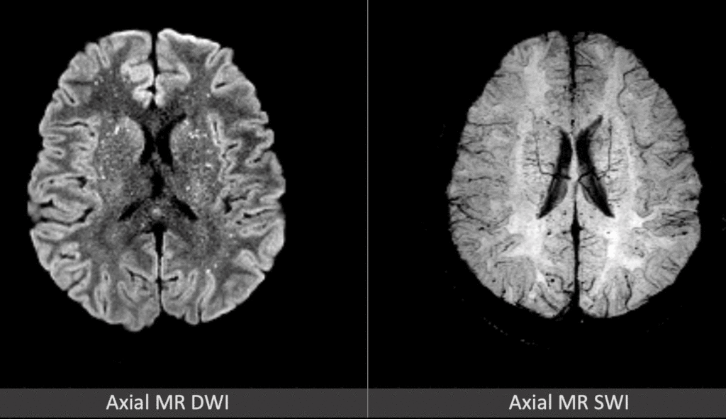 MRI cross section of the brain