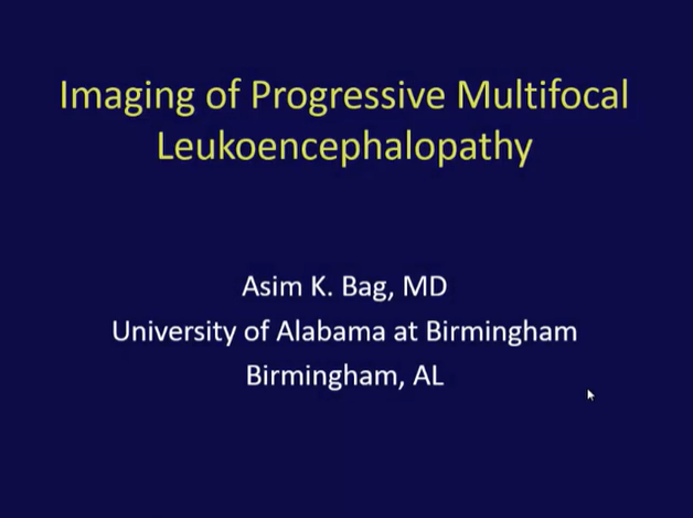 Imaging of Progressive Multifocal Leukoencephalopathy thumbnail
