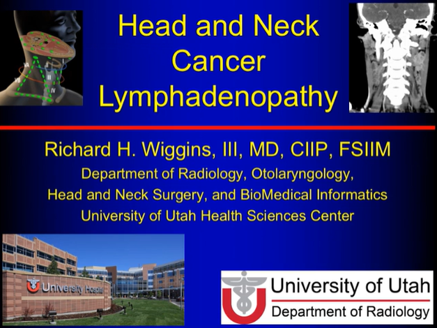 Head and Neck Cancer: Lymphadenopathy thumbnail