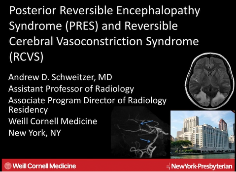 Posterior Reversible Encephalopathy Syndrome (PRES) & Reversible Cerebral Vasoconstriction Syndrome (RCVS) thumbnail